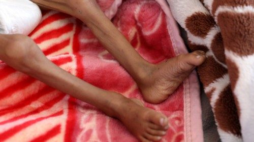 A malnourished girl lies on a bed at the malnutrition treatment ward of al-Sabeen hospital in Sanaa, ...