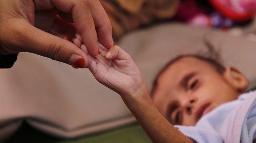 epa07170876 A Yemeni woman holds a hand of her malnourished child as he receives medical attention ...