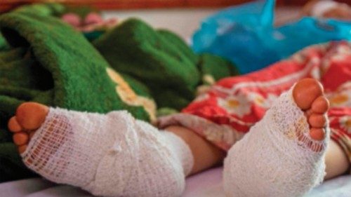 A wounded girl lies on a hospital bed after receiving treatment following shelling on a residential ...