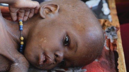 Nura Ismail Ali, 4, a malnourished Somali child displaced by the worsening drought due to failed ...
