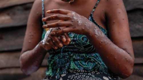 A patient suffering from mpox, sits on a bench at the Kavumu hospital, 30 km north of Bukavu in ... A patient suffering from mpox, sits on a bench at the Kavumu hospital, 30 km north of Bukavu in ...