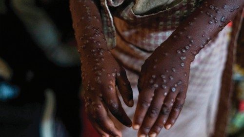 EDITORS NOTE: Graphic content / A patient with a severe form of the mpox epidemic is treated at the ...