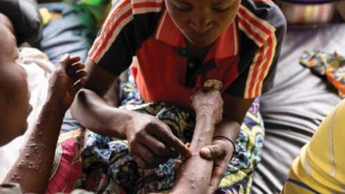 Migliaia di contagi in Africa per il vaiolo delle scimmie QUO-212 Migliaia di contagi in Africa per il vaiolo delle scimmie QUO-212