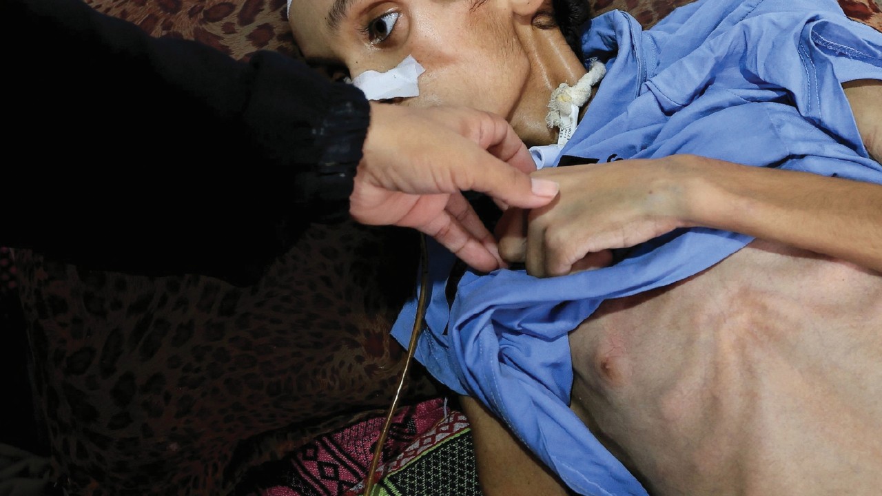 Palestinian boy Mosab Al-Debs, 14, who is malnourished according to medics, lies on a bed at ...